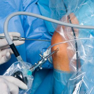 knee artiscopy updated
