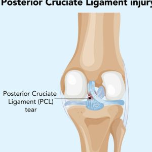 ligament injury