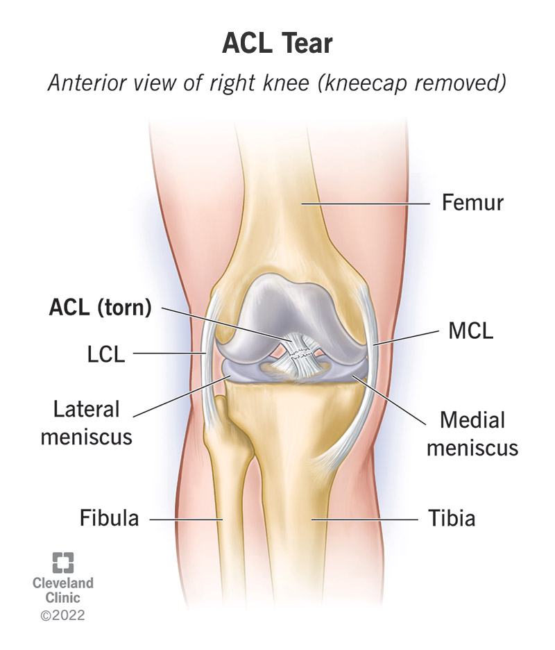 chatgpt ligament injury2